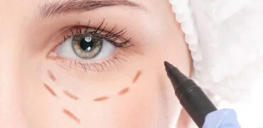 Plástica Pálpebras (Oculoplástica)