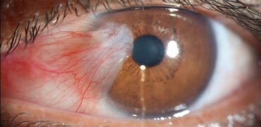 Cirurgias IOMC 5 Transplante Conjuntival