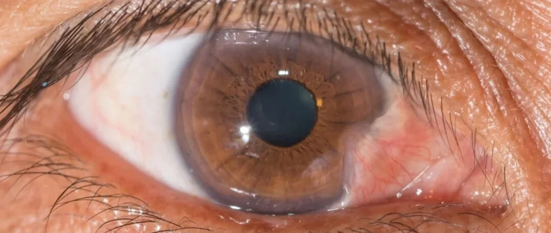 Transplante Conjuntival IOMC 1 Transplante Conjuntival